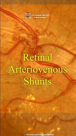 Retinal Arteriovenous Shunts. Branch Retinal Vein Occlusion. #retina #ophthalmology #optometry