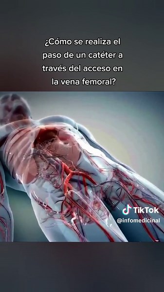 Uso del catéter en la vena femoral: procedimiento detallado