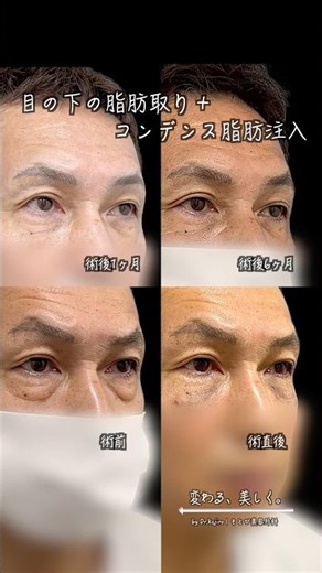 目の下で「なんとなく暗く見える」は変わる｜クマ治療の経過（直後→1ヶ月→6ヶ月）