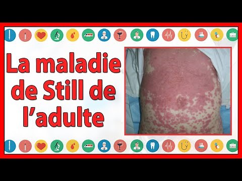 La maladie de Still de l’adulte : quel profil clinique, para clinique et évolutif ?