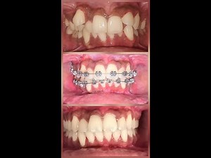 Class II Division I Malocclusion with Severe Anterior crowding and Deepbite treated Non-Extraction