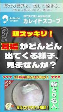 【珍耳垢】耳垢がどんどん出てくる様子、見ませんか？