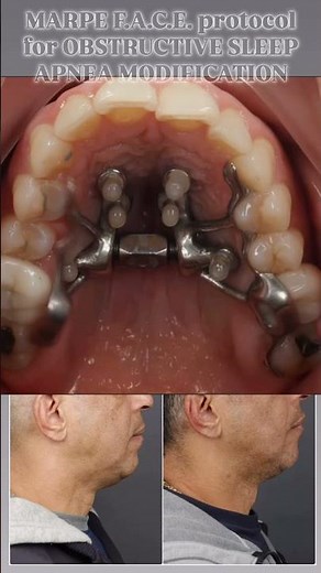 MARPE F.A.C.E. protocol for OBSTRUCTIVE SLEEP APNEA