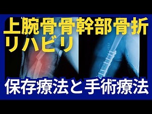上腕骨骨幹部骨折リハビリテーションに重要なこと保存療法と手術療法の特徴