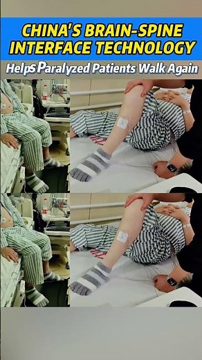 China's brain-spine interface technology helps paralyzed patients walk again #Shanghai #tech #BSI