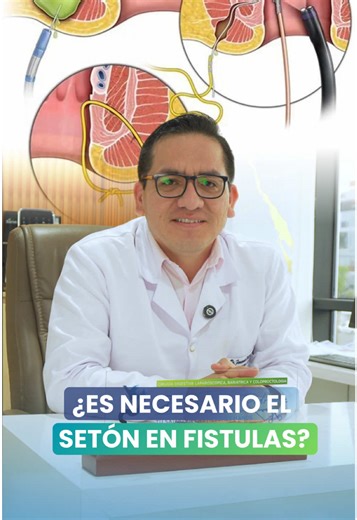 🚨 ¿Te indicaron un seton para tratar una fístula? El seton es una herramienta útil, pero generalmente se utiliza de forma temporal para controlar la infección y preparar el tratamiento definitivo. Mantenerlo por periodos prolongados sin una indicación clara no siempre es lo adecuado. Cada caso debe ser evaluado correctamente para evitar tratamientos innecesarios o prolongados. Infórmate y busca siempre una valoración especializada. 📲 Agenda tu cita al 938 766 903 👨‍⚕️ Dr. Fernando Rodríguez –
