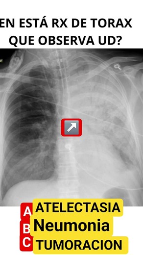 😱 El 90% se equivoca con esta radiografía de tórax! #medicina #medicina #anatomiafacil #neumologia