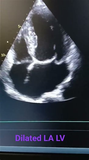 2 d echo #dilated left atrium and left ventricle