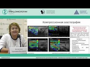 Ultrasound diagnostics of thyroid cancer (Kostromina E.V.)