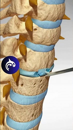 See how an Artificial Cervical Disc Replacement of the Spine works in 3D animation.
