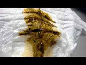 Why Is My Poop Black And Green