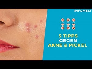 Die 5 besten HAUSMITTEL gegen PICKEL - Akne Behandlung Tipps - Mitesser und Akne entfernen