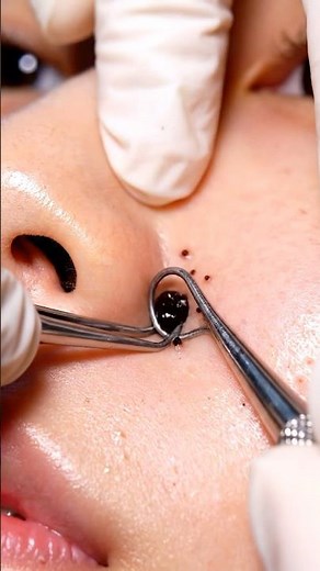 Giant Blackheads Removal | Deep Clogged Pores Fully Cleaned