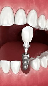 Dental implant and ceramic crown. Medically accurate tooth 3D Animation
