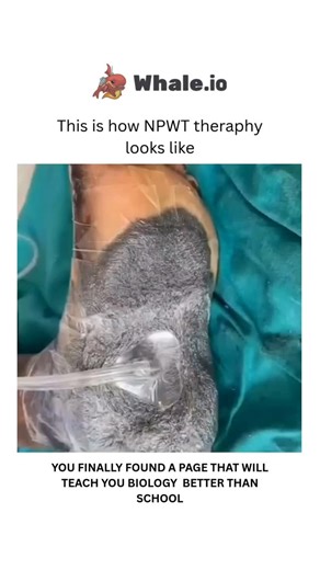 Medical on Instagram: "NPWT (Negative Pressure Wound Therapy) is a medical treatment that promotes wound healing by applying a vacuum dressing to enhance blood flow, reduce fluid, and promote granulation tissue growth. It's often used for chronic or complex wounds, such as diabetic foot ulcers, pressure sores, or post-surgical wounds. Dm for credit or removal🙏 #viralreels #explore #science #knowledge #BiologyNerd #bio #biologyfacts #BiomedicalScience"