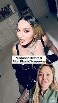 Madonna before and after plastic surgery. #madonna #facelift #plasticsurgeon