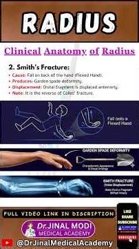 Colles vs Smith's Fracture: 1 Minute Mastery! 🦴