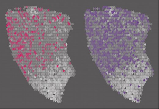Stanford Medicine-designed AI tools tackle soft tissue sarcomas, identify new treatment strategies