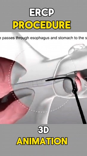 ERCP procedure 3d animation video #ercp #endoscopy #animation #medical