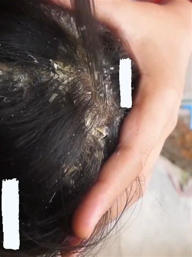 Dandruff dreams floating in midnight air | Flake Lab