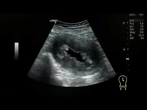 Endometrial carcinoma ultrasound