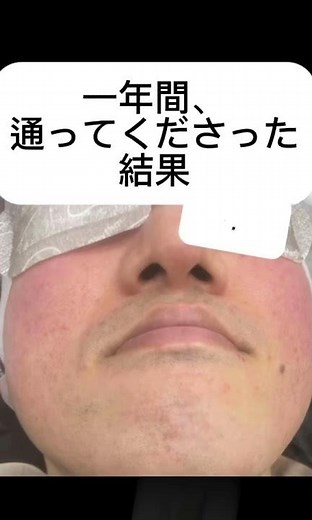髭脱毛（ひげだつもう）を美容室で✨光脱毛を1年された方の比較動画をご紹介❗️男性専用美容室ブラックビズ #shorts