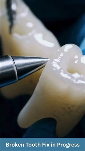 Smoothening a Broken Tooth Extreme Close-Up Dental Grinding