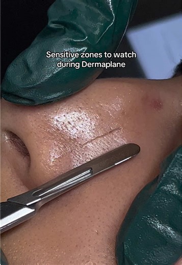 Educational Dermaplane Awarness Post ✨ Dermaplaning is all about precision, Some areas of the face need extra care especially around the nose, mouth, and brows. These zones have thinner, more mobile skin or unique contours that make them more sensitive. Proper technique = smooth results   happy skin ☺️ #sacramentoesthetician #smoothskin #dermaplane #viral #facialcare