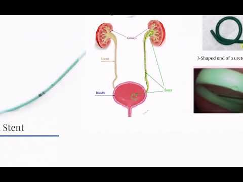 Ureteral Stent