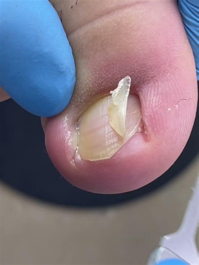 Easily trim ingrown toenails that are red and swollen! #nails