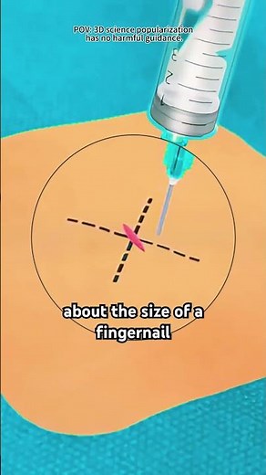 How PEG Tube Procedure Is Done(3D Animation)