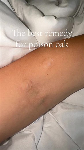 The best remedy for poison oak is pimple patches 🫡 #poisonoak #poisonoakremedy