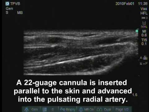 Radial Artery Cannulation under Ultrasound Guidance