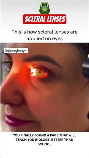 This is How Scleral Lenses are Applied on Eyes #shorts #medical $#bio #biology #trending