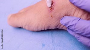 doctor treats weeping wound, trophic ulcer on female leg, wound exudate prevents healing ulcers by destroying growth factors, concept eliminating inflammatory process, sanitation pathogenic microflora