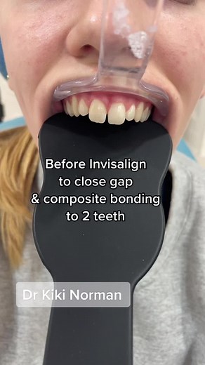 Closing Gap with Invisalign and Composite Bonding