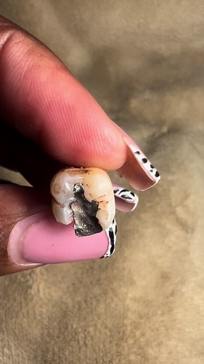 Amalgam Filling Side Effects and Alternatives Explained