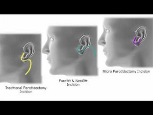 Micro Parotidectomy & Facial Reconstruction | Babak Azizzadeh, MD, FACS