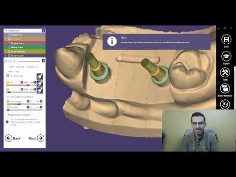 wax up in exocad شرح بالعربي