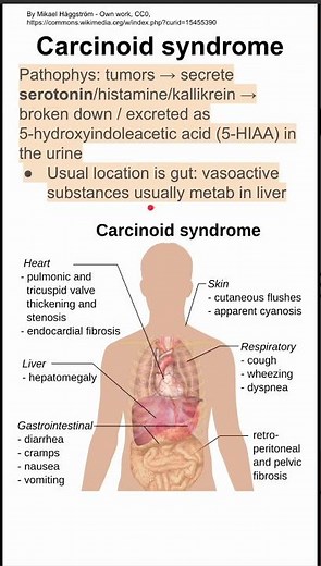 Carcinoid syndrome