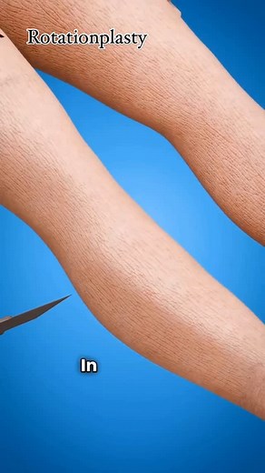 Holistic Health Treatment on Instagram: "Follow (us) @norelie.co for more pain relief and nerve health tips. Rotationplasty is a surgical procedure that involves rotating a portion of the leg, typically 180 degrees, to create a new, functional limb. The lower leg is rotated, and the ankle joint becomes a functional knee joint, allowing for weight-bearing and movement. This procedure is often performed to treat bone cancer, severe trauma, or congenital limb abnormalities, with the goal of preserv