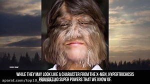 10 REAL People With Shocking Genetic Mutations