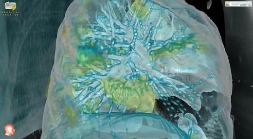 1.2M views · 2.1K reactions | GW Hospital Uses Innovative VR Technology to Assess Its First COVID-19 Patient Surgical Theater 360 degree VR helps doctor and patients to look inside the damaged lung by COVID-19 virus. #Covid #Corona #Covid19 https://www.gwhospital.com/resources/podcasts/covid19-vr-technology | Surgical Theater | Facebook