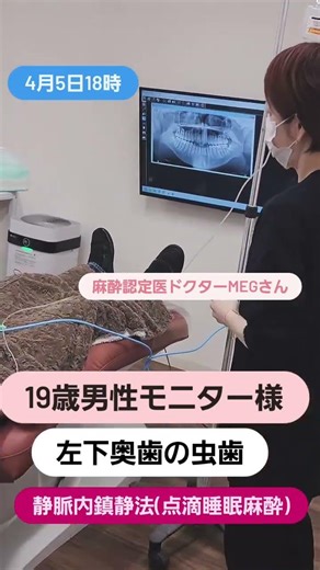 静脈内鎮静法(点滴睡眠麻酔)併用での奥歯の虫歯治療ですこちらの男性は19歳の方。10代の方でも歯科治療が苦手な方は活用してくださいませ#静脈内鎮静法#インプラント#セラミック#セラミック矯正#睡眠麻酔