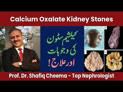 Calcium Oxalate Kidney Stones , Causes & Treatment by The Best Nephrologist in Lahore