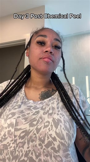 Janiameshell (@janiameshell01)’s video of chemical peel