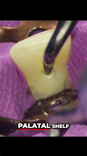 Accessing a Central Incisor Step by Step Dental Guide
