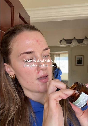 How to Deal with Angry Pimples Effectively