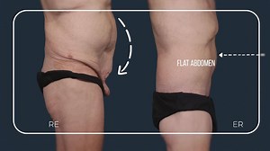 Circumferential Body Lift