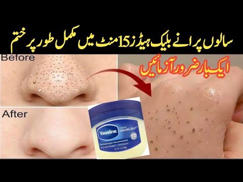 How To Remove BLACKHEADS Permanently From Nose & Face Instantly 💯| Naturally at Home | No Whiteheads